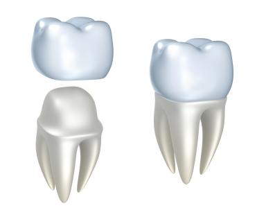 Clinica dentale Mansueto - Capsule Dentali