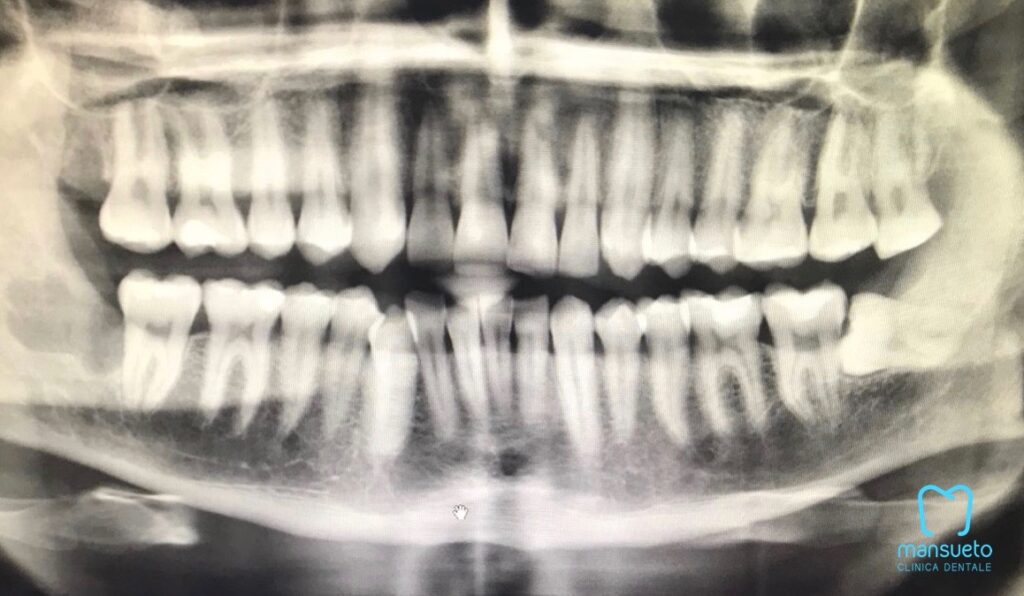 Clinica dentale Mansueto - Dente del Giudizio