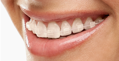 Clinica dentale Mansueto - brackets